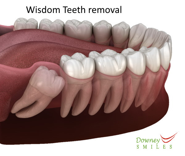 wisdom teeth removal bruising
